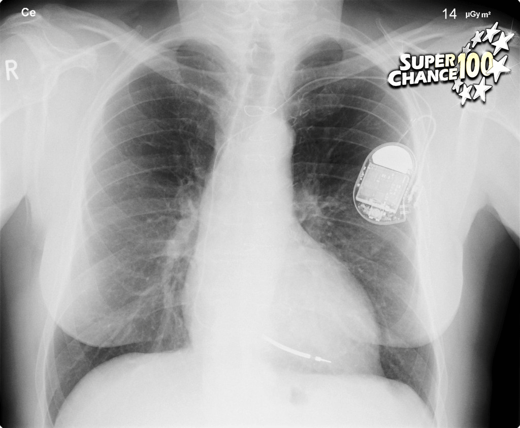 Radiographie d'un individu portant un pacemaker.
